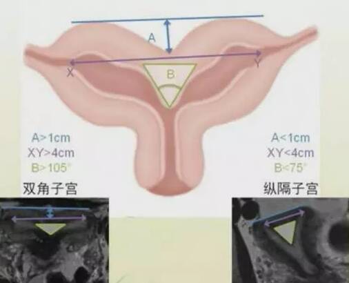 为什么会出现双角子宫 双角子宫对女性怀孕的影响有哪些