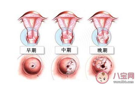 女性哪些人容易得宫颈癌 如何预防宫颈癌的产生