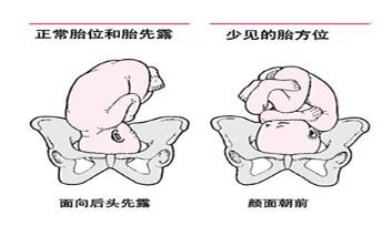 什么叫胎位异常？胎位异常的原因有哪些？