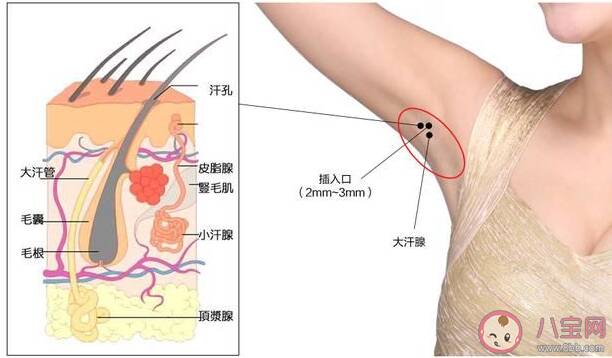 腋臭和狐臭有什么区别 腋臭和狐臭是一样的吗