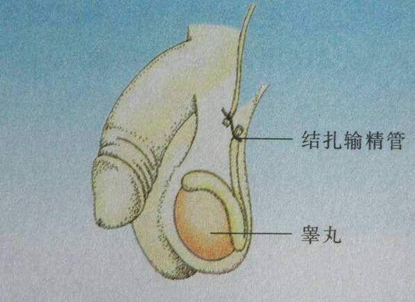 男性结扎后精子去哪里了 男性结扎后还能射精吗