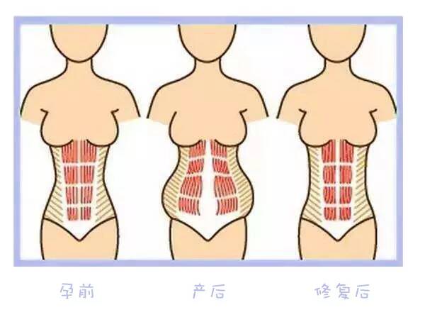 生完孩子后肚子还是很大是什么原因 生完孩子肚子大是不是腹直肌分离