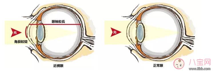 孩子生活中喜欢把眼睛眯着是近视了吗 孩子眯眼看电视近视吗