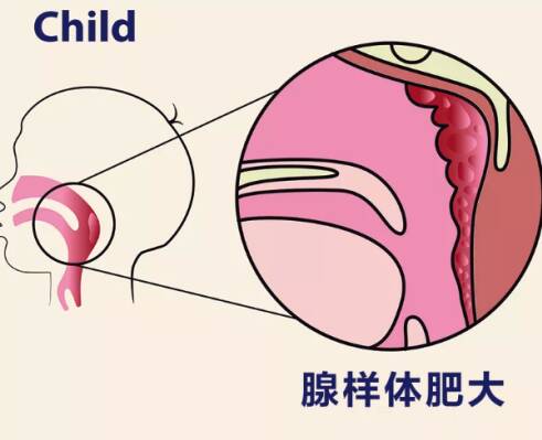 宝宝腺样体肥大怎么办 腺样体肥大能治好吗