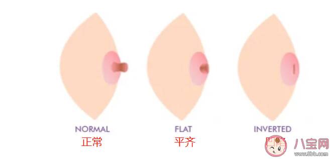 怎样的乳头算内陷 怎么判断乳头内陷的严重程度