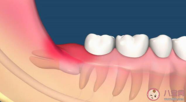 智齿没疼过也要拔吗 为什么智齿那么疼