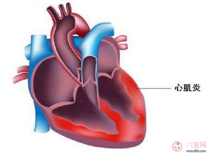 病毒性心肌炎严重吗 小孩爆发性心肌炎很坑医生吗
