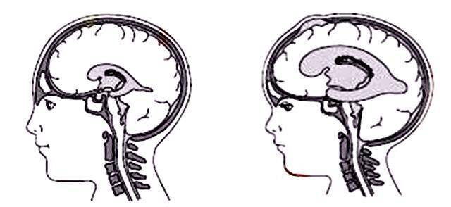 脑袋大的小孩是聪明还是脑进水？细说脑积水的种种危害