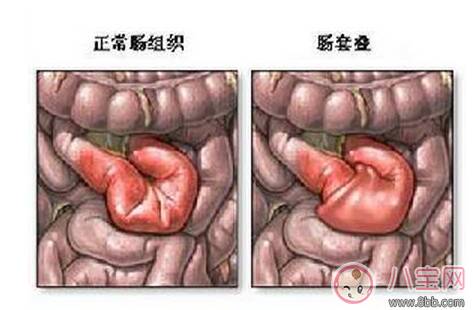 宝宝肠套叠是怎么引起的 肠套叠需要动手术吗