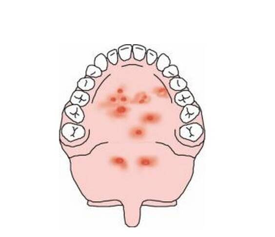 疱疹性咽峡炎是什么病 怎么预防疱疹性咽峡炎2022