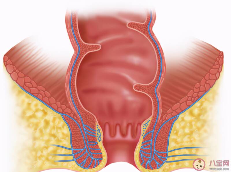 挑痔法能够根治痔疮吗 痔疮不治疗能自己好吗