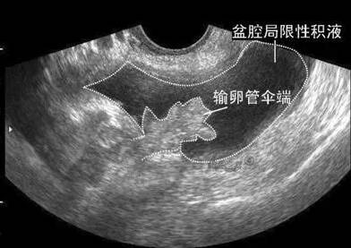 盆腔积液怀孕后会出血吗 盆腔积液影响怀孕吗