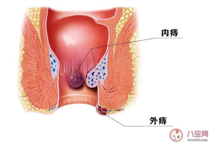 痔疮能彻底根治不再复发吗 痔疮反复是保守治疗还是手术