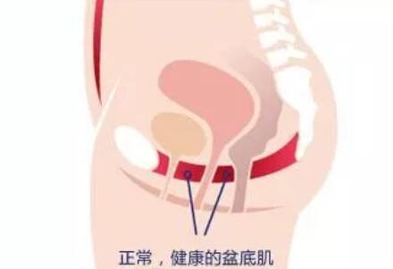 剖宫产要做盆底肌治疗吗 剖宫产不做顺产才做盆底肌治疗吗