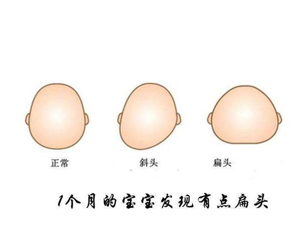 孩子扁头会不会影响孩子智力发育 孩子睡扁头好还是不好