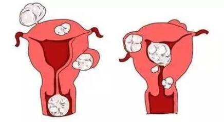 有子宫肌瘤想生娃要手术吗 有子宫肌瘤想生娃怎么手术