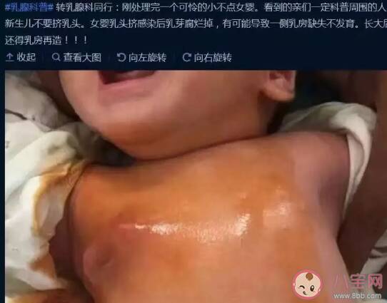 宝宝刚生出来就挤乳头好吗  新生女宝要不要挤乳头