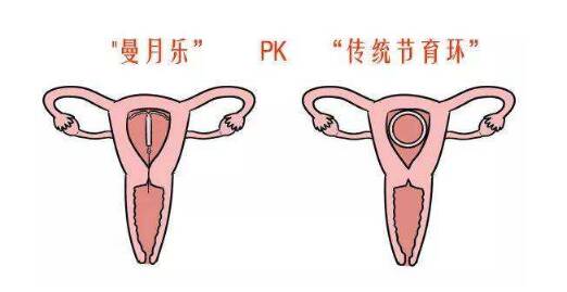 曼月乐环适用哪种人 带曼月乐环都有哪些效果