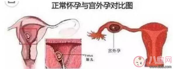 试管怀孕可以避免宫外孕吗 试管怀孕怎么样