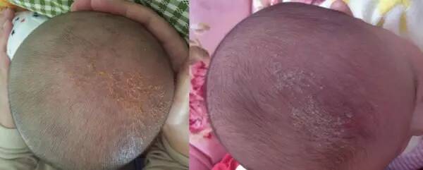 宝宝的乳痂是怎么形成的 宝宝头上有黑色结痂物是正常的吗