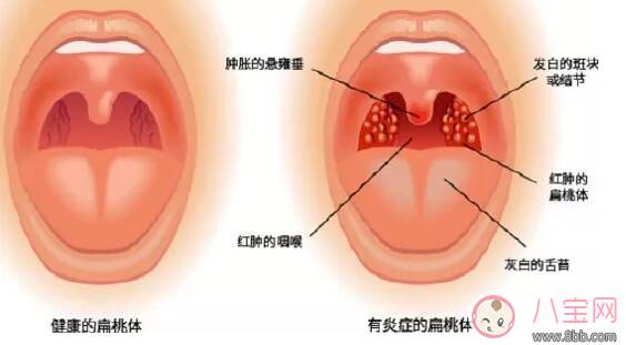 孩子扁桃体炎反复可以切了吗 孩子经常得扁桃体炎怎么办