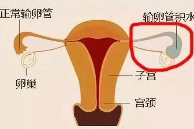 输卵管积水能做试管婴儿吗 输卵管积水怎么预防2022