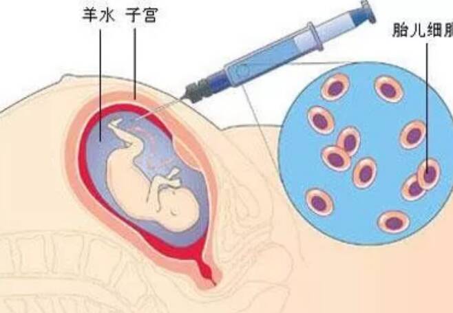 羊膜穿刺术怎么看生男生女 羊膜穿刺术生男生女判断方法