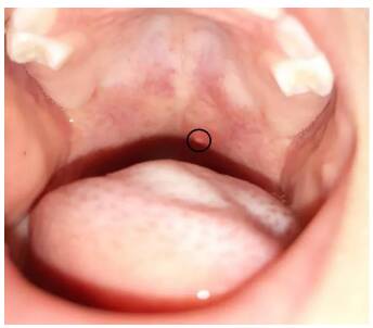 判断孩子的病是不是疱疹性咽峡炎方法 疱疹性咽峡炎和与手足口病有什么区别