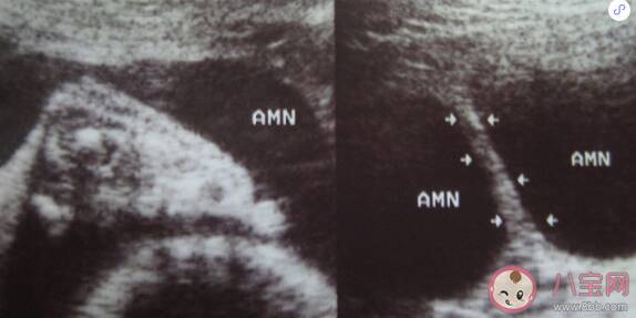 羊膜带怎么成形  羊膜带对宝宝有影响吗