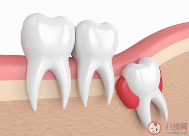 智齿是如何被拔出的 哪种智齿必须要拔