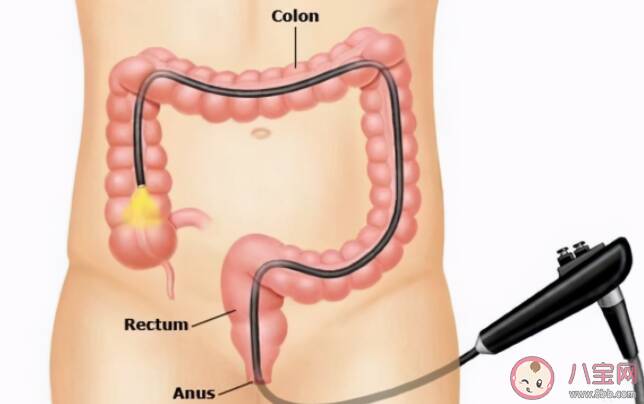 肠镜检查到底疼不疼 肠镜前1天饮食怎么吃