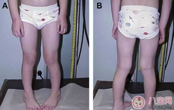 宝宝走路内八字怎么办 宝宝走路内八字的原因有哪些