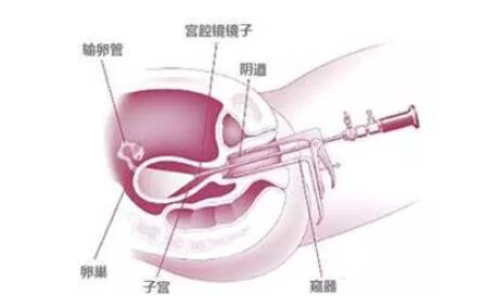 电刀手术对内膜损伤大真的吗 宫腔镜电刀手术安全吗