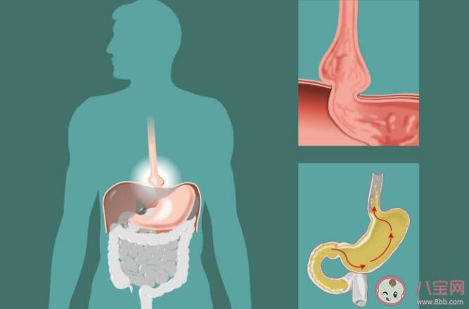 胃食管反流病为什么一停药就复发 如何预防胃食管反流复发