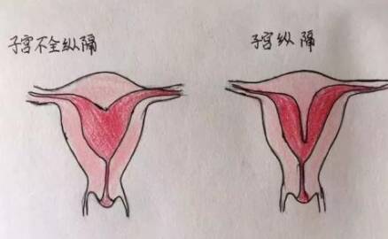 纵膈子宫治疗方法 子宫纵膈治疗一定要手术吗