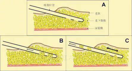 深圳悦美莉医疗门诊部钟奇博士告诉您面部吸脂完美术后完美无痕