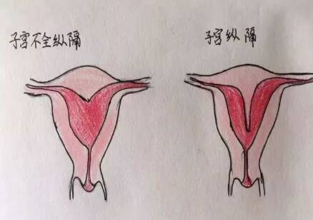 什么是纵隔子宫 纵隔子宫会导致女性长期不孕吗