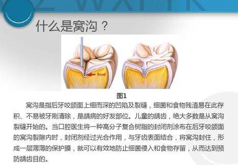 应该给孩子做窝沟封闭吗 给孩子做窝沟封闭的好处