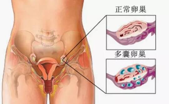 多囊卵巢成功怀孕的经历2022 多囊卵泡质量差促排有效果吗