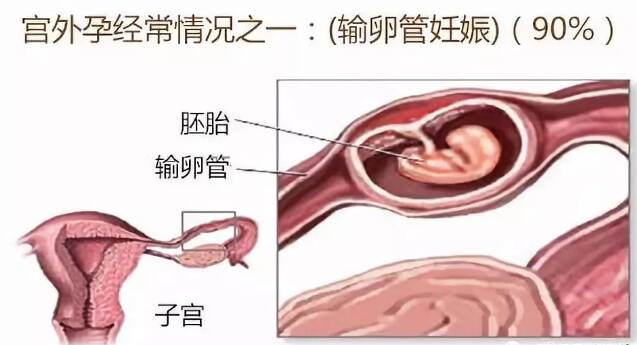 子宫外孕选择药物治疗还是手术治疗 子宫外孕的治疗方式有哪些