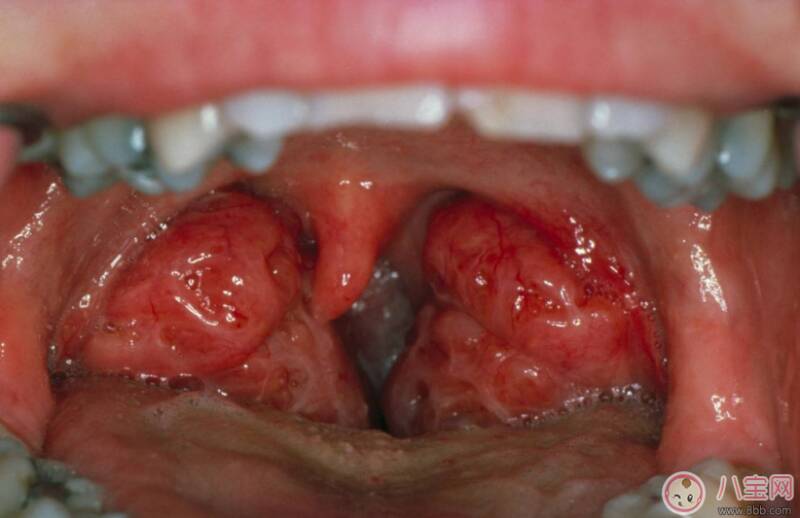 宝宝扁桃体发炎怎么预防 孩子扁桃体有炎症怎么办