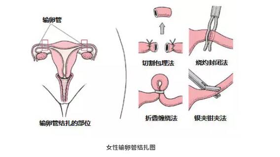 女性上环后还能怀孕吗 上环后还想要小孩怎么办