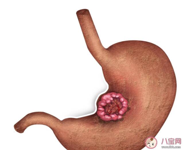 我们的胃到底是怎么坏的 5个方法护胃健康