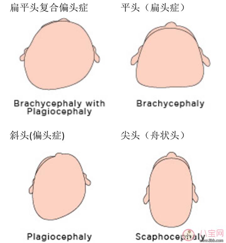 预防宝宝平头扁头 婴儿如何塑造好头型 定型枕头没用