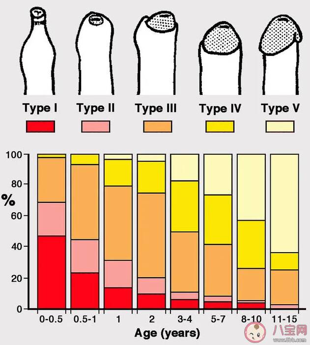 男孩包皮多长算正常 如何定义包皮过长