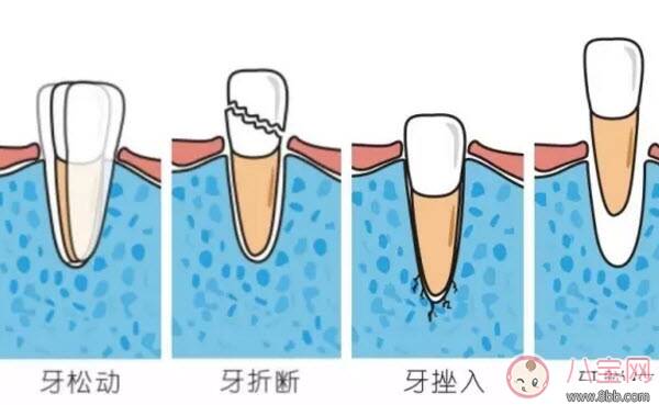 宝宝乳牙摔伤怎么处理 乳牙摔伤松动折断挫入脱出紧急处理方法